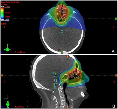 Upright proton therapy for esthesioneuroblastoma: a single-institution experience